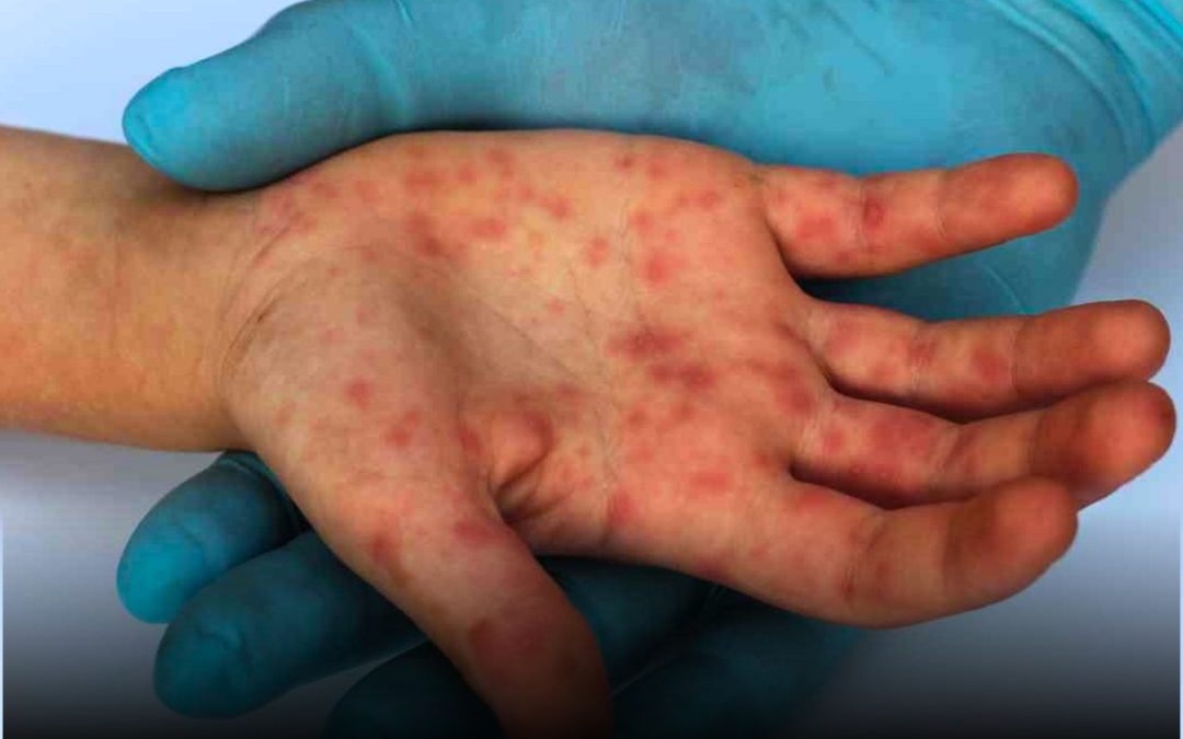 Secretaría de Salud confirma primera muerte por sarampión en 2026